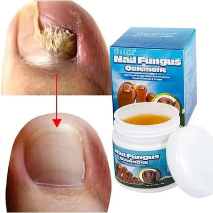Sumifun Nail Repair Ointment – Fungal Treatment & Nail Restoration